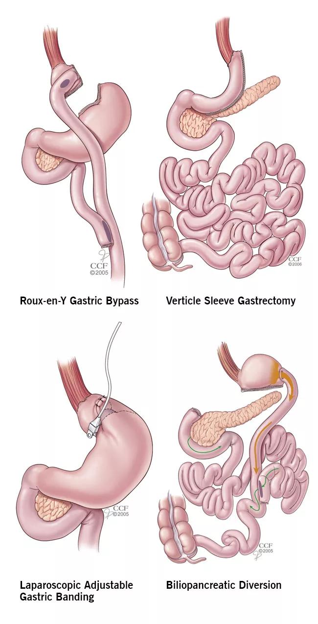Figure 1: Diagrams of the four bariatric operations currently in common clinical use.