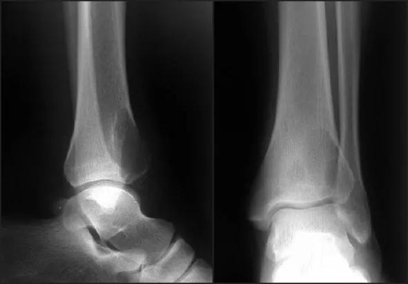 Figure 1. Radiographs from a case of giant cell tumor of bone showing sharp margination and a cookie cutter-type appearance.