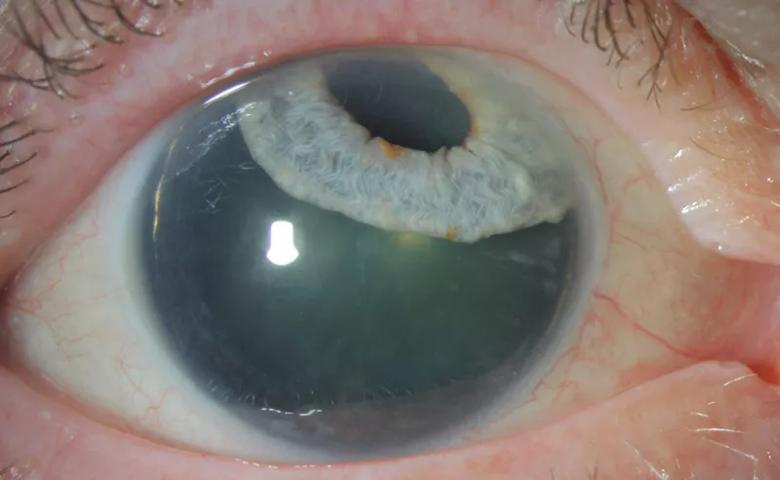 Eyeball with iris slid upward