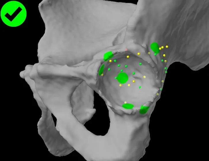 Robotic planning of hip replacement