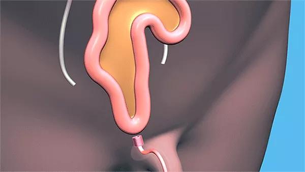 Cleveland-Clinic-Bladder-Reconstruction