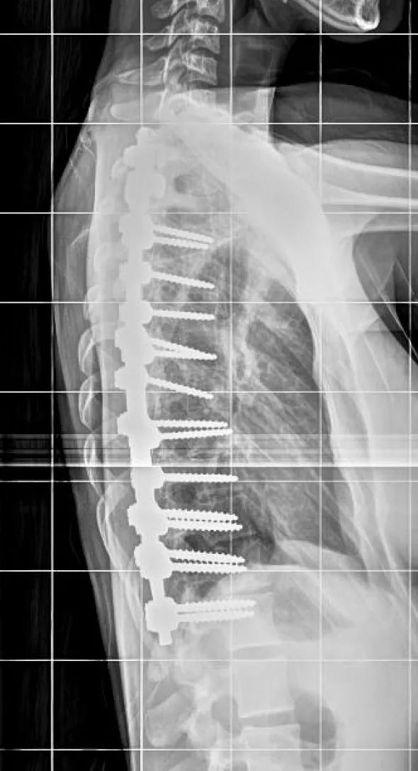 Caption: Standing posteroanterior and lateral radiographs of a 15-year-old female patient three years after posterior spine fusion for scoliosis. She returned to tumbling (photograph) and gymnastics six months postoperatively. 