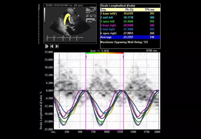 Example of a resting left ventricular global longitudinal strain echo obtained for the study.