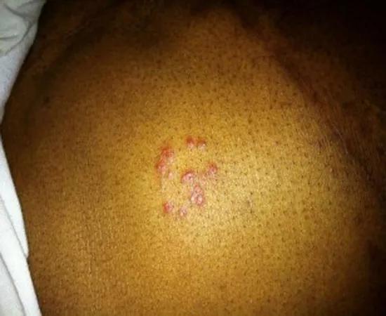 Skin complication