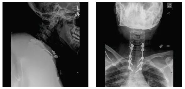 benzel-tumor-fig4