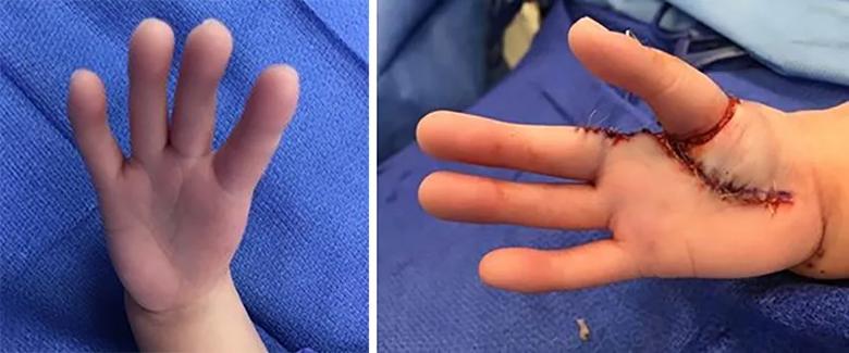 Before and after pollicization to treat type V hypoplastic thumb.