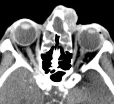 16-eye-2531-potts-cqd-inset-2