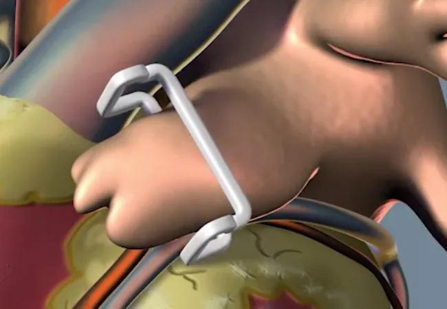 Illustration of the Gillinov-Cosgrove™ LAA Clip