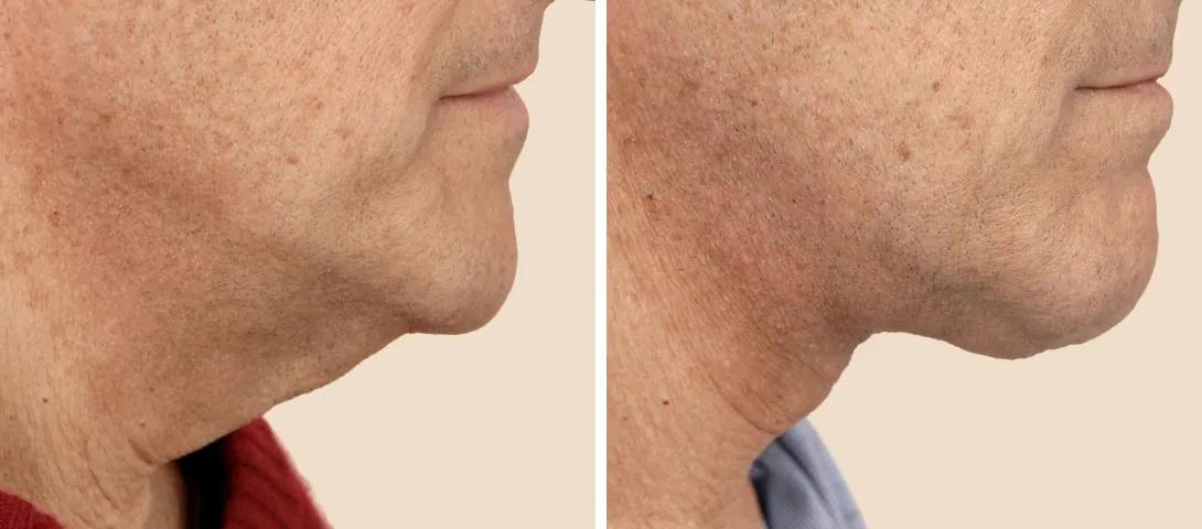 Side View - Before and After