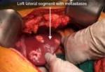 First-stage hepatectomy to clear metastases from the left lateral segment.