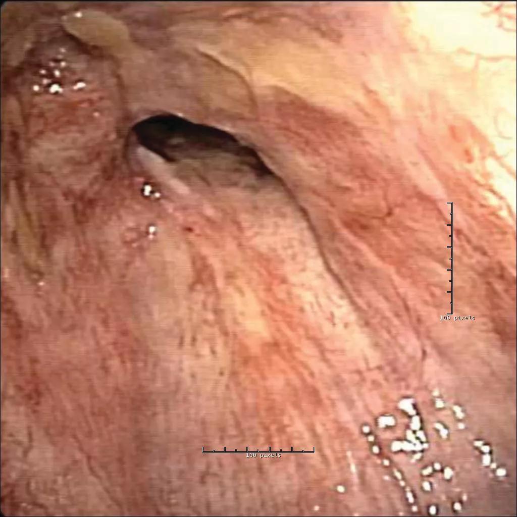 Midtracheal stenosis.