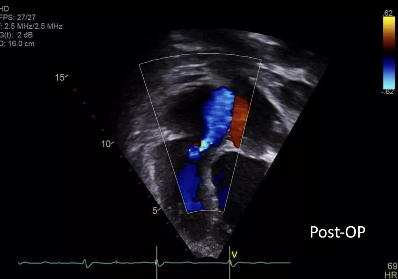 echocardiogram showing mild tricuspid regurgitation