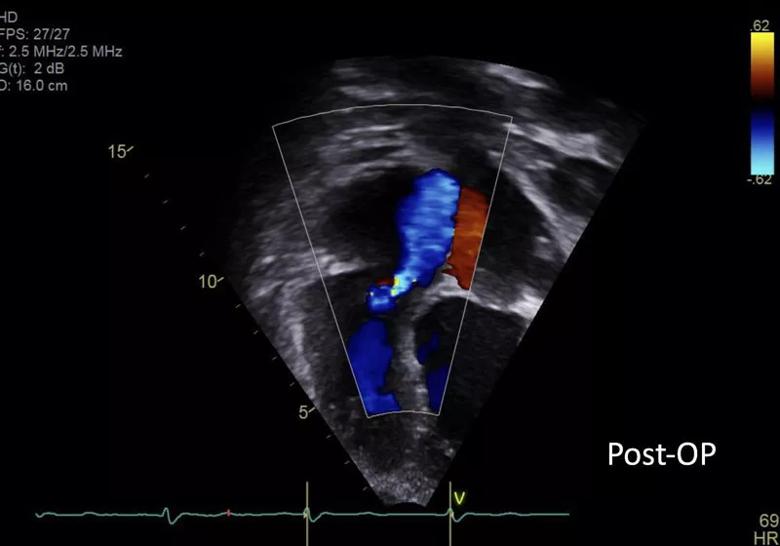 echocardiogram showing mild tricuspid regurgitation