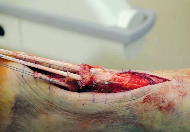 Not Your Average Rupture: Hamstring Graft for Reconstruction of 