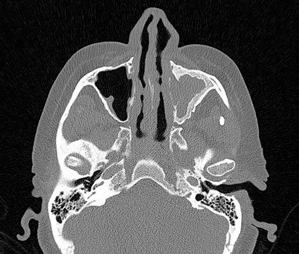 Abatacept-CT_Fig-Top_Langford_590pxl-width