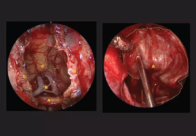 Left: Endoscopic view of the defect shows the optic chiasm (A), the anterior communicating artery (B), the frontal lobe (C) and the dural edges (D). Right: A view of the center (A) and perimeter (yellow line) of the fascia flap. 