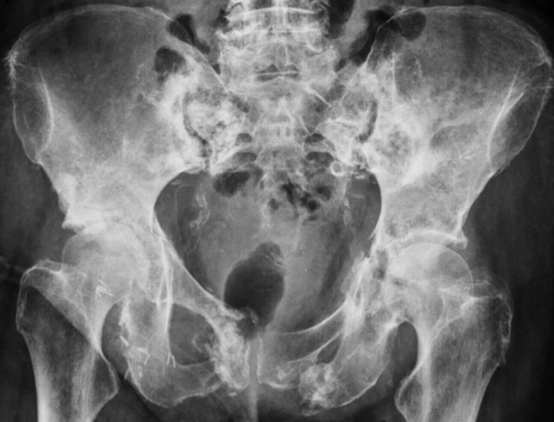 X-ray of pelvic fractures