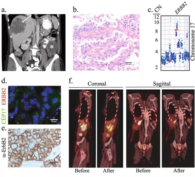 Clinical course and molecular profiling of the primary tumor