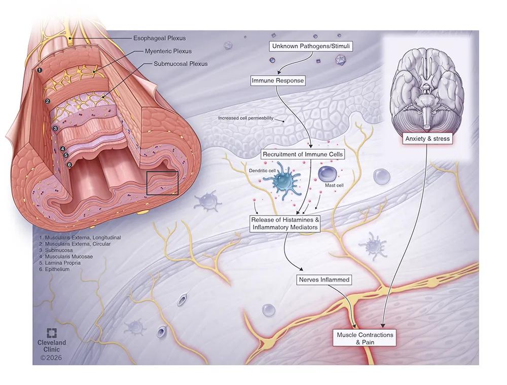 Functional Heartburn illustration