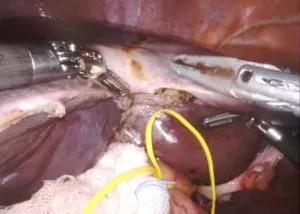 liver resection