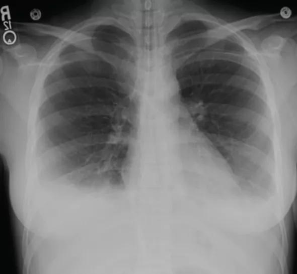 Figure 1. Radiograph showing pleural and pericardial effusion in the case patient.