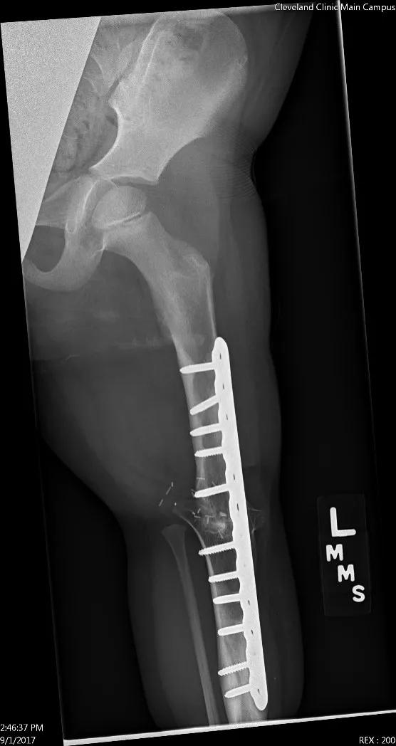 Rare surgery helps young patient with osteosarcoma