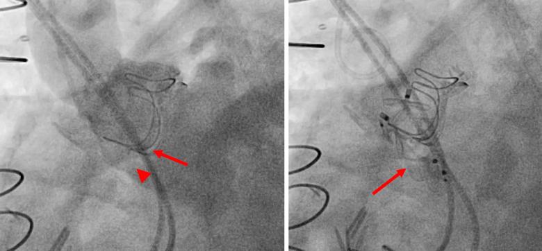 two angiograms of the heart after placement of a bioprosthetic valve