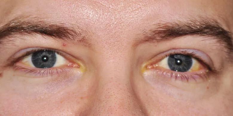 Patient eye