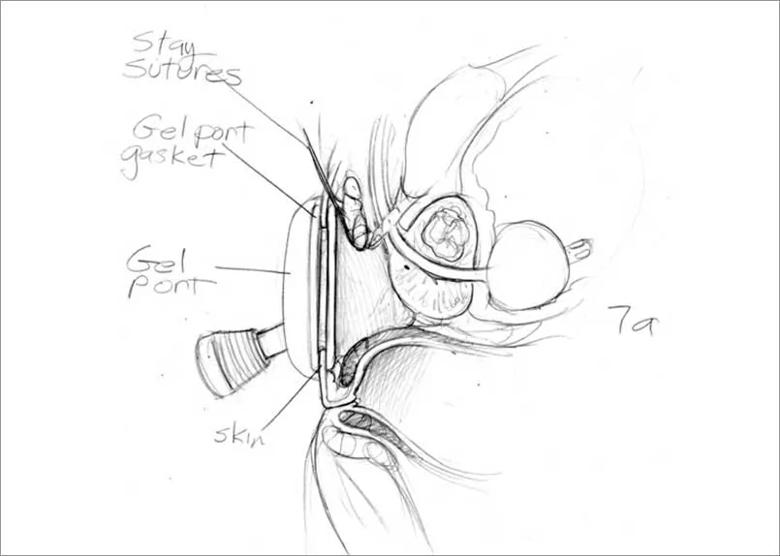 Medical drawing of perineal prostatectomy