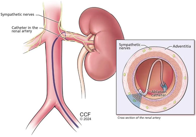 Depiction of renal denervation