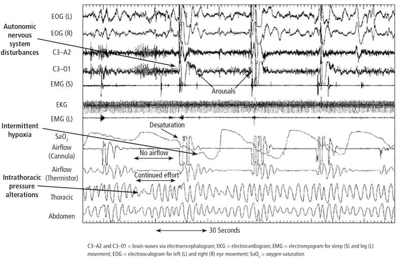 A polysomnogram showing autonomic nervous system disturbances.