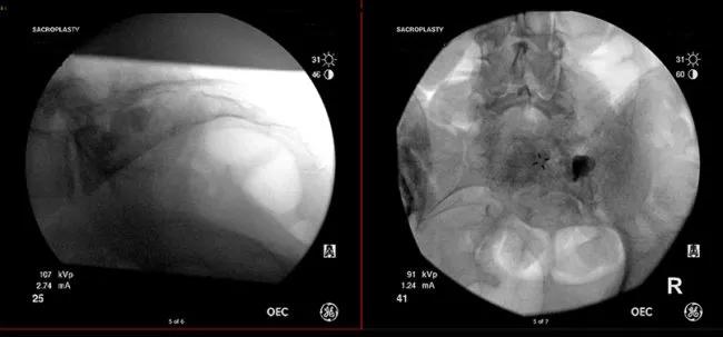 Antero posterior and lateral images after injection of cement and pulling out the instruments