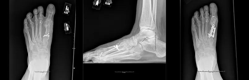 X-rays