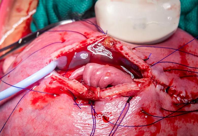 The fetus’s left hand is visible as the uterine incision is closed.