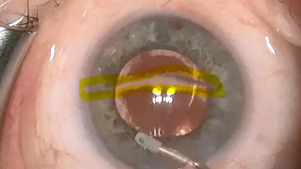 Eye with a strip of trabecular meshwork remaining after glaucoma surgery