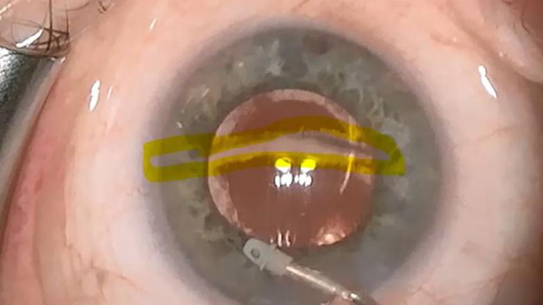 Eye with a strip of trabecular meshwork remaining after glaucoma surgery