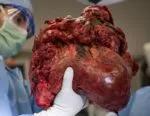 Removal of the native organs.