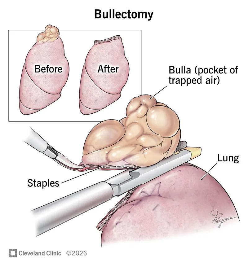 Lung before and after a bullectomy procedure to remove a bulla (pocket of trapped air)