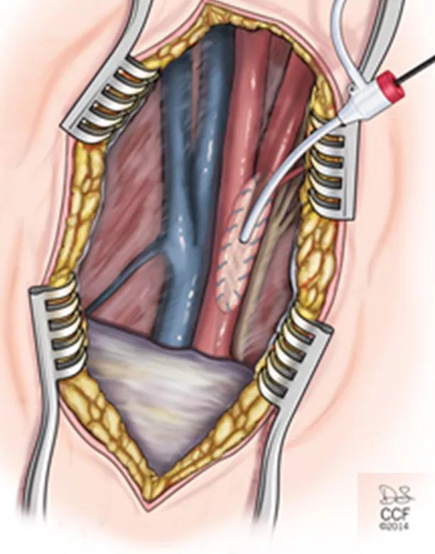 carotid patch retrograde sheath access for tandem carotid artery lesions
