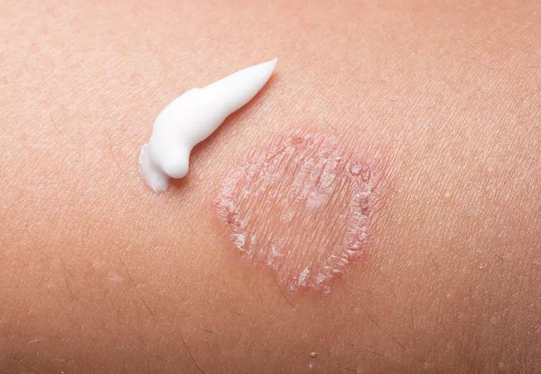 Circular Rash: Common Causes That Aren't Ringworm