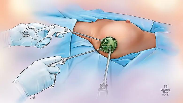 illustration of endoscopic mastectomy procedure