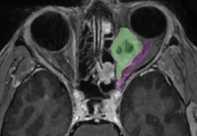 Orbital tumor