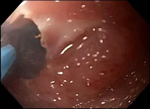 stricture