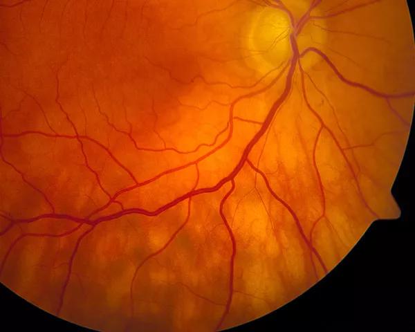 Ocular Adnexal Lymphoma Masquerading as Glaucoma