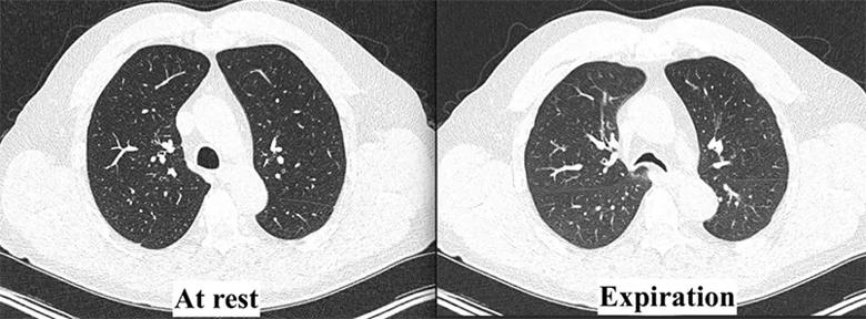 dynamic lung computed tomography