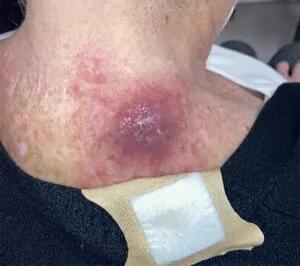 Photo of skin cancer lesion at start of treatment