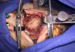 Figure 6. Soft palate reconstructed with radial forearm free flap