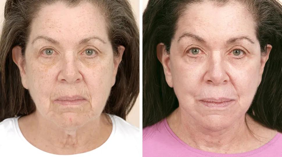 Facelift before & after photo