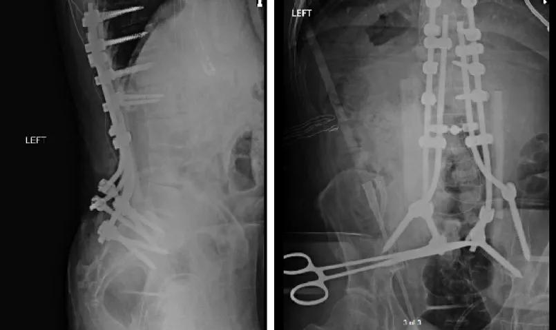 two imaging scans of a human spine with implanted screws