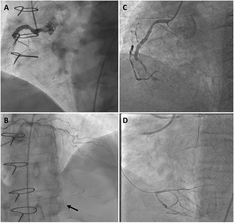 four scans showing heart vessels before and after a cardiac procedure